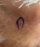 Right central forehead - Before Treatment