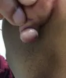 Left posterior lower lobe - Before Treatment