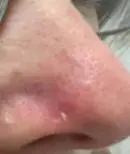 Right lateral nose - During Treatment