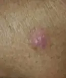 Left elbow - After Treatment