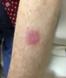 Left Mid Forearm - During Treatment