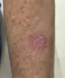 Left Mid Forearm - Last Treatment