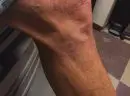Right lateral knee - After Treatment