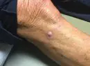 Right lateral knee - Before Treatment