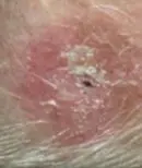 Scalp - During Treatment
