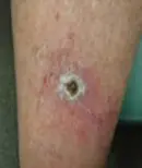 Shin - Before Treatment
