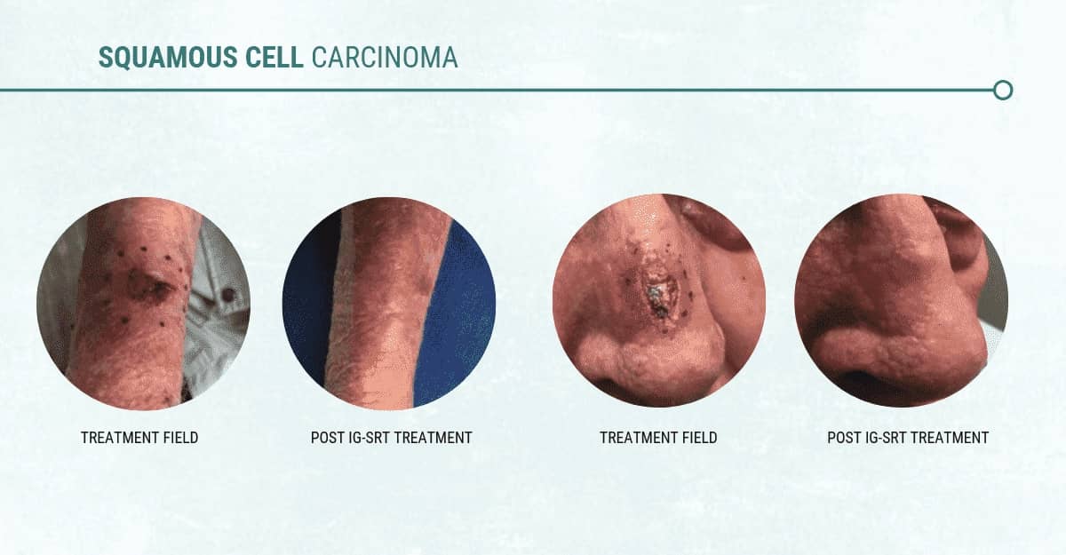 Squamous cell carcinoma before and after treatment
