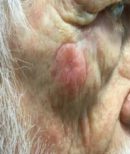Right central malar cheek - After Treatment