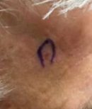 Right central forehead - Before Treatment