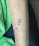 Left Mid Forearm - Before Treatment