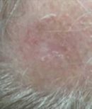 Scalp - After Treatment