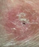 Scalp - During Treatment