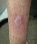 Shin - After Treatment