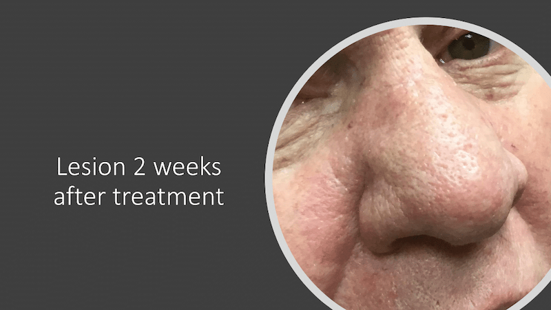Man's nose two-weeks post completion of treatment with Image-Guided SRT for basal cell carcinoma on the nose