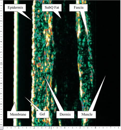 Skin Under Ultrasound with Labels