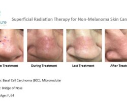 Before, during and after images of treatment of basal cell carcinoma on bridge of nose with Image-Guided SRT