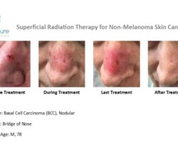 Before, during and after images of treatment of basal cell carcinoma on bridge of nose with Image-Guided SRT