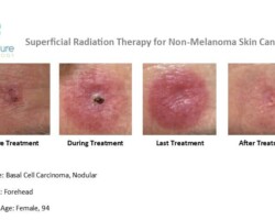 Before, during and after images of basal cell carcinoma treated on bridge of nose with Image-Guided SRT