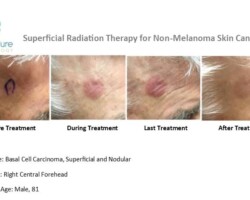 Before, during and after images of basal cell carcinoma on a forehead treated with Image-Guided SRT