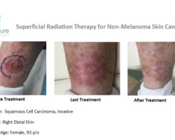 Before, during and after images of squamous cell carcinoma on a shin treated with Image-Guided SRT