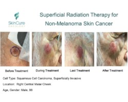 Before, during and after images of squamous cell carcinoma on a cheek treated with Image-Guided SRT
