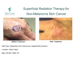 Before and after images of squamous cell carcinoma on a hand treated with Image-Guided SRT