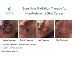 Before, during and after images of squamous cell skin cancer on a person's left post auricular treated with Image-Guided SRT
