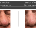 basal cell carcinoma on nose treatment with Image-Guided SRT after fifteen treatments and after twenty treatments