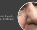 Man's nose two-weeks post completion of treatment with Image-Guided SRT for basal cell carcinoma on the nose