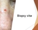 Biopsy site basal cell carcinoma on nose