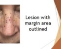 Basal cell carcinoma on nose - lesion with margin area outlined