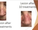 basal cell carcinoma on nose treatment with Image-Guided SRT after five treatments and after ten treatments