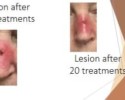 basal cell carcinoma on nose treatment with Image-Guided SRT after fifteen treatments and after twenty treatments