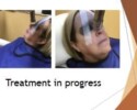 Basal cell carcinoma treatment with Image-Guided SRT in progress